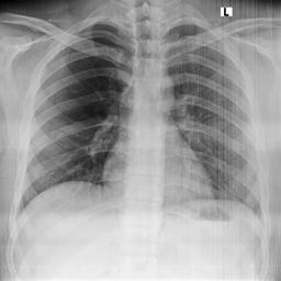 Normal Chest X-Ray 2