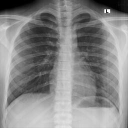 Normal Chest X-Ray