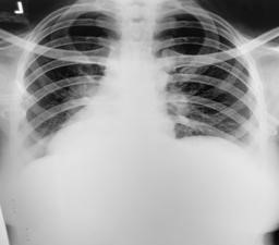 TB Positive Chest X-Ray
