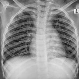 TB Positive Chest X-Ray 2